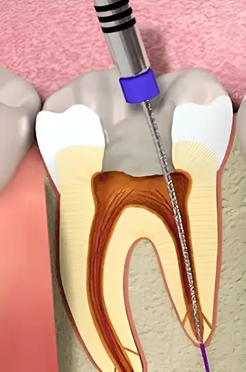 Imagen de Endodoncia